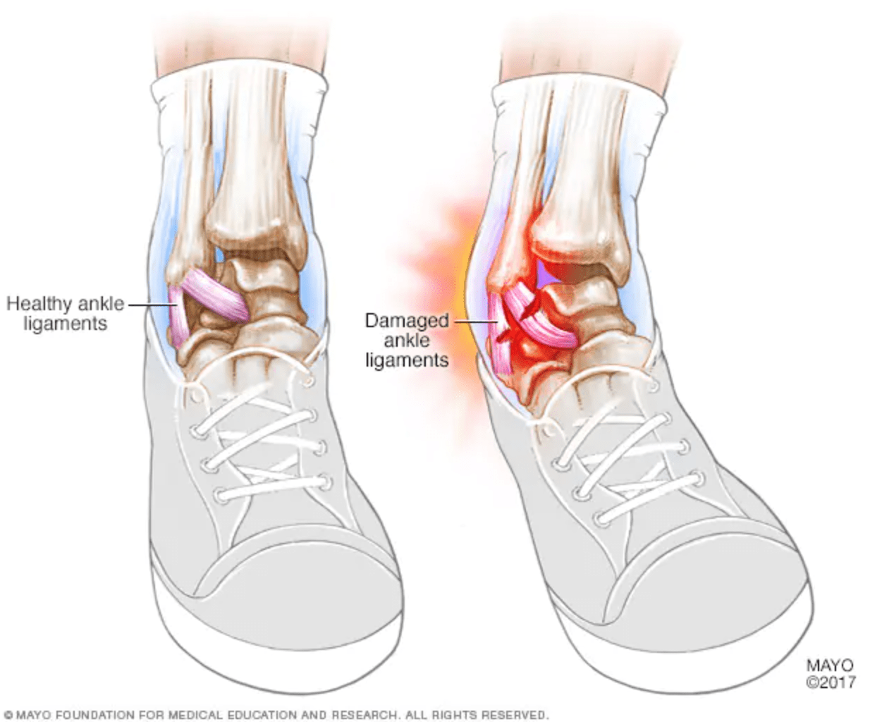 Ankle Sprain Recovery - What You Need To Be Aware Of Howard Beach, NY